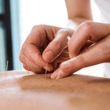 Acupuncture